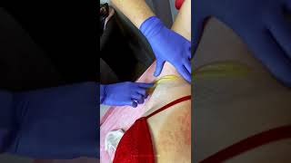 Underarm sugaring procedure 2 - Sugaring Factory