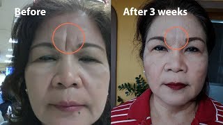 DEEP FROWN LINE TREATMENT