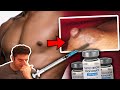 He Injected Testosterone Into His Gyno And This Is What Happened...