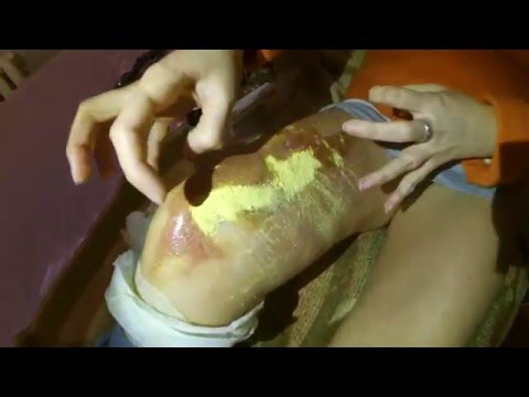 Как и Чем Лечить Ожог