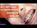 Кривые зубы что делать. 😁 Как сделать выбор метода исправления кривых зубов. Мать и Дитя Кунцево.