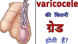 varicocele की ग्रेड कैसे पता करें || grades of varicocele Hindi || varicocele की कितनी ग्रेड होती है