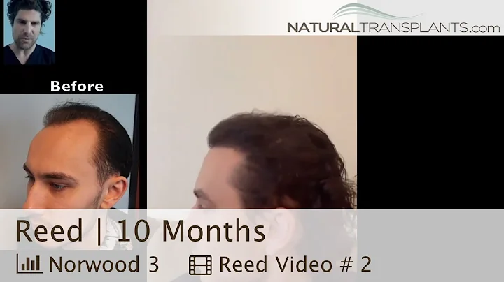 Second Hair Transplants Results Natural Transplant...