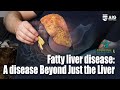 Fatty liver disease a disease beyond just the liver  aig hospitals