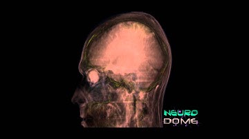 Volumetric rendering of human CT Scan