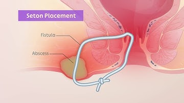 Seton placement for perianal fistulas | TVASurg