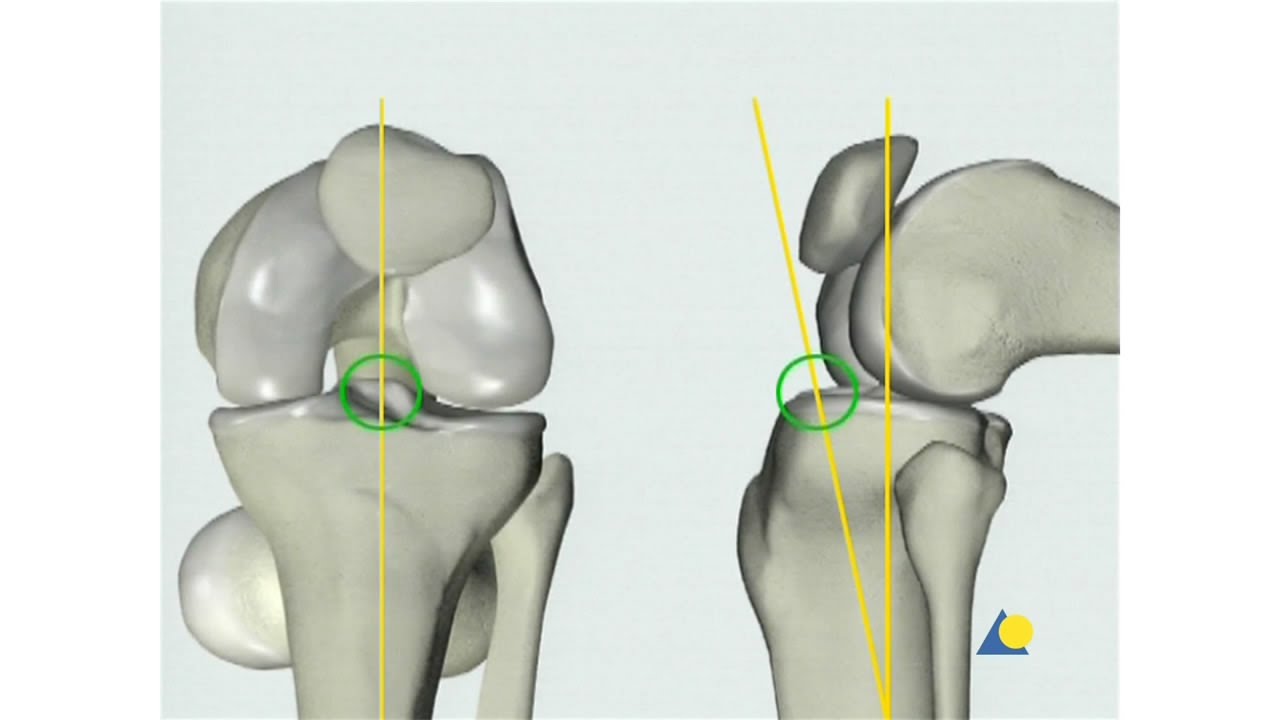 Surgical Management of Ipsilateral Fracture of the Femur and Tibia in  Adults (the Floating Knee): Postoperative Clinical, Radiological, and  Functional Outcomes