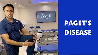 Pagets Disease