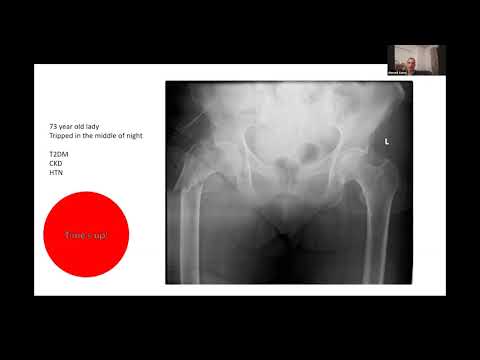 Subtrochanteric fracture (31A3) -  viva practice for FRCS & Orthopaedic exit exams