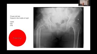 Subtrochanteric Fracture 31A3 - Viva Practice For Frcs & Orthopaedic Exit Exams