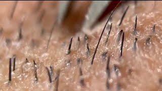 ぬるピ 癒しの髭抜き その23 【ヒゲ抜き】【毛抜き】 - YouTube