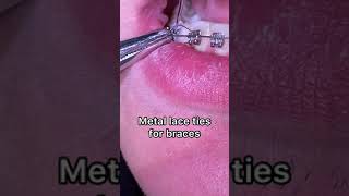 Braces on | Metal lace ties for braces | Tooth Time Family Dentistry New Braunfels Texas
