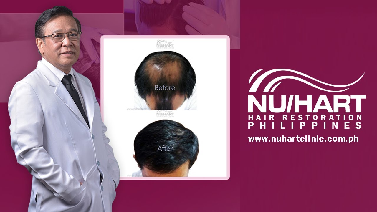 Philippines No. 1 Clinic in FUE Hair Transplant YouTube