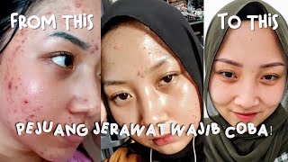 PERJUANGAN SEMBUH JERAWAT PAKE ERHA ACNE ACT~