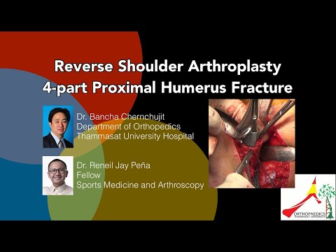 ReverseTotalShoulderArthroplasty-RTSAFractureProximalHumerusข้อไหล่เทียมชนิดกลับด้านกระดูกไหล่หัก