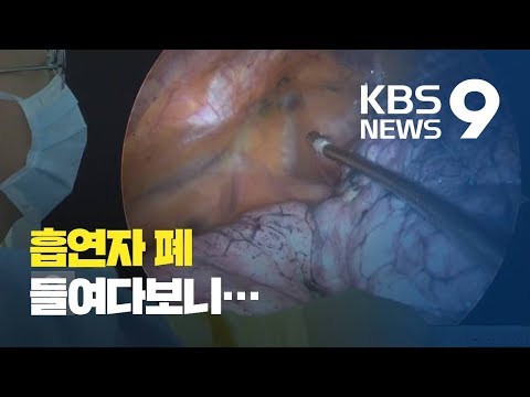 폐 내시경 영상 입수 30년 흡연 폐 모습 충격 KBS뉴스 News 