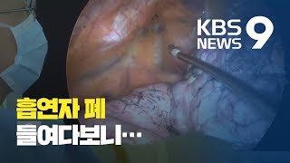 폐 내시경 영상 입수…‘30년 흡연 폐’ 모습 충격 / KBS뉴스(News)