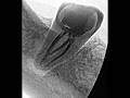 Mandibular second molar with interesting canal configuration, MB joining with Distal canal#endo #rct