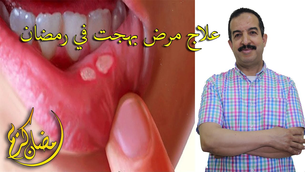 علاج مرض بهجب في رمضان