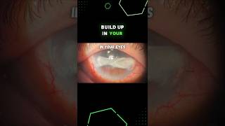 Hard Calcium Salt Deposits in Your Eyes!