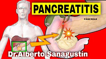 ¿Puede la pancreatitis aguda causar muerte súbita?