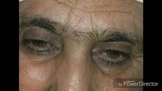 Steroid induced cataract (history taking in pashto)