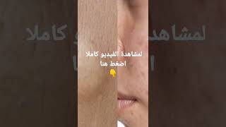 اسرع طريقة للتخلص من الحبوب تحت الجلد والحبوب البيضاء