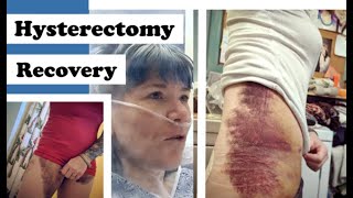 Hysterectomy Surgery & Recovery