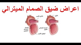 سؤال و جواب : ما هي اعراض ضيق الصمام الميترالي ؟ كيف يتم تشخيص ضيق الصمام التاجي ؟