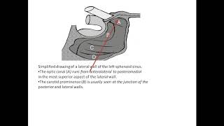 Lateral Wall Of Sphenoid Sinus