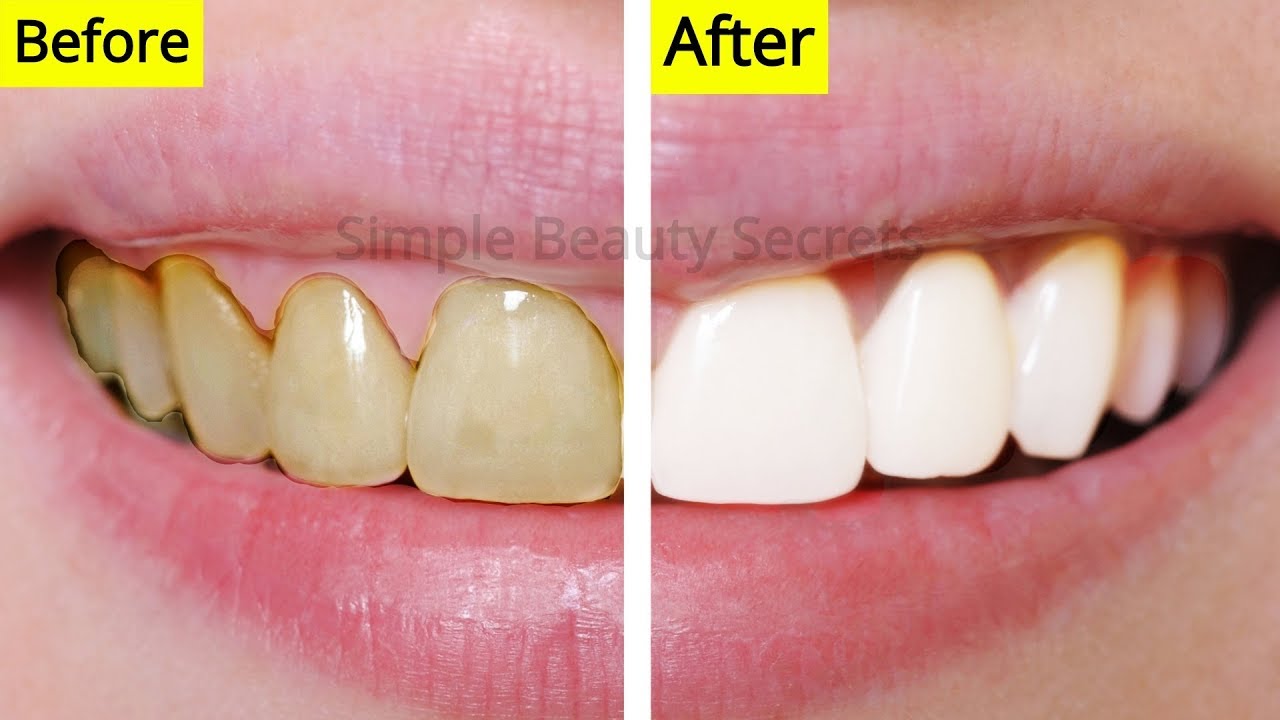 How To Whiten Your Teeth Naturally At Home Remove Plaque & Stains