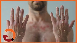 🐒What Is Monkeypox? The Symptoms, How It's Spread, And Risk To The Public | Tiggio