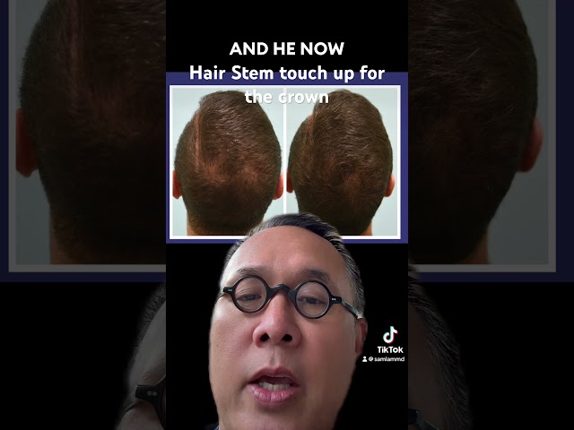 Hair Stem touch up for the crown