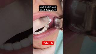 خطوات تركيب تلبيسات سيراميك على زرع اسنان