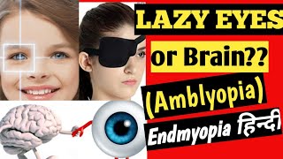 Lazy eye | Amblyopia | Patching | Endmyopia Hindi | कैसे ठीक करे |How to treat lazy eye in kids|#8