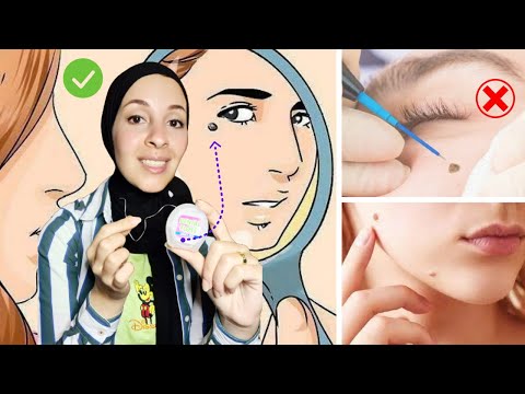 بهذه الطريقة تخلصت من الزوائد الجلدية والشامات بدون جراحة   
