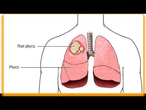 Jak się objawia rak płuc — objawy, które powinieneś znać!