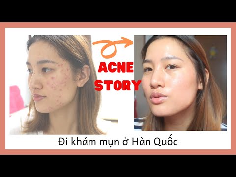 NHẬT KÝ TRỊ MỤN TRONG HƠN 1 THÁNG CỦA MÌNH! Trị mụn ở Hàn Quốc | Bình Soo