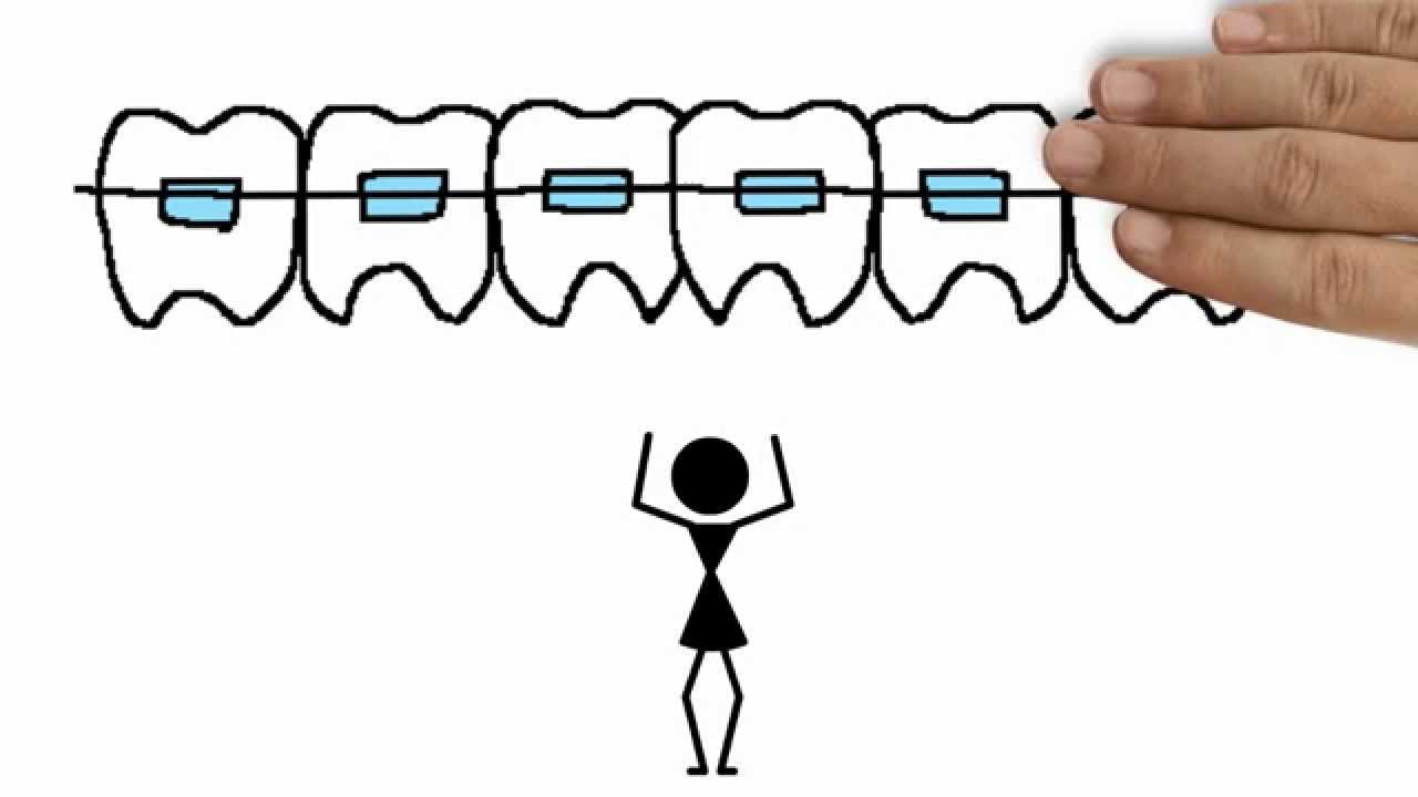 Can You Still Get Braces If You Have Fillings?