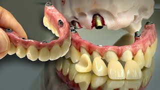 Challenging Ceramic Buildup on Multi-System Implants with Angled Channels