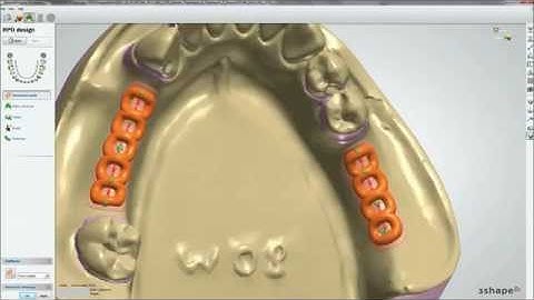 3Shape Scanner - Removable Partial Design