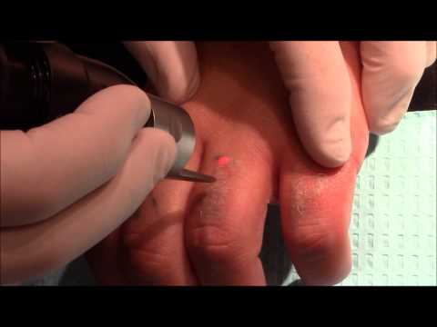 Dr. Bruce Katz Uses the New Picosure Laser to Remove a Tattoo