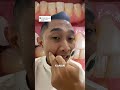 CARA MENYIKAT GIGI YG BENAR AGAR GUSI NYA TIDAK TURUN SAKIT DAN BENGKAK #caramenyikatgigi