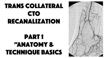 Part 1 Trans-Collateral CTO Recanalization (Basic Anatomy and Technique)