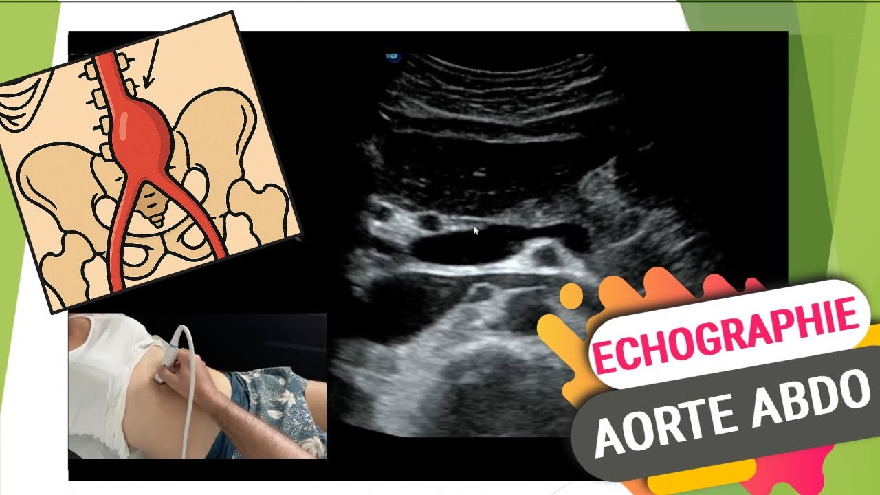 Echographie de l'aorte abodominale: découvrez un extrait exclusif de la formation doppler niveau 2