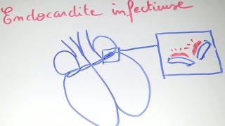 SmartN'Easy - Infective Endocarditis! - Dr. Astuce