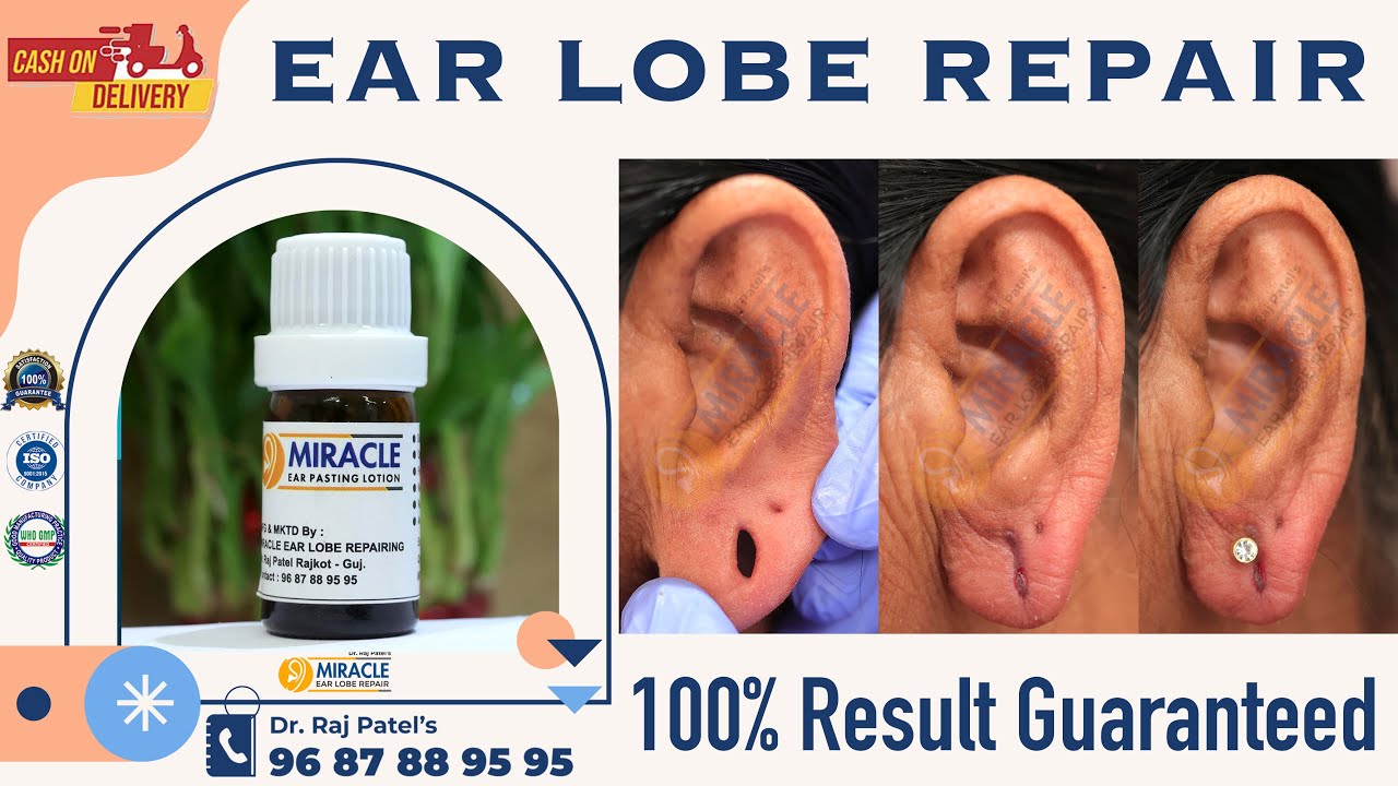 Earlobe / Hole Repair By Ear Pasting lotion / Ear Repair/ Torn Ear