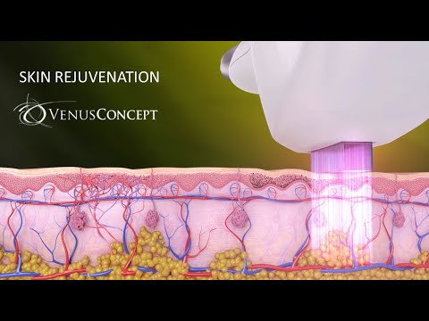 Skincare and Skin Rejuvenation - Aesthetic Treatments With Venus Versa (Medical Device 3D Animation)