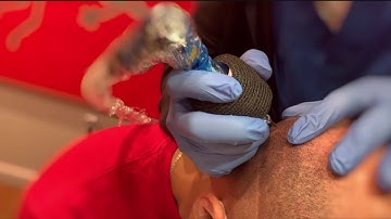 Dallas Scalp Micropigmentation