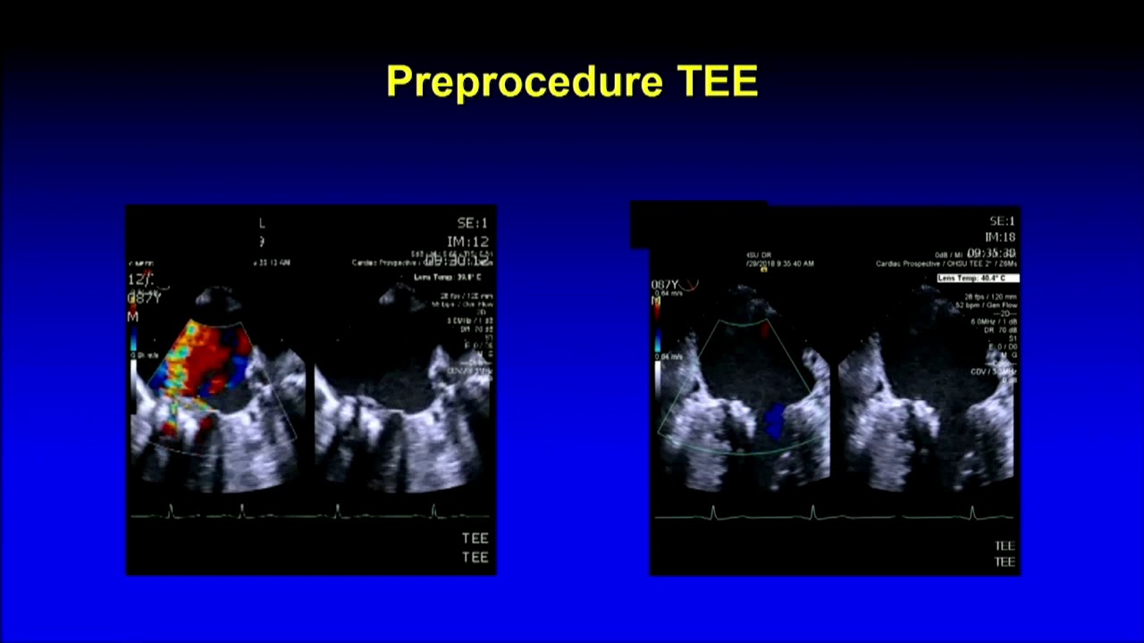 CVI 2019_Friday 7/19_ The Boundaries of Structural Heart Therapy I _Firas Zahr, MD interventional cardiology salary